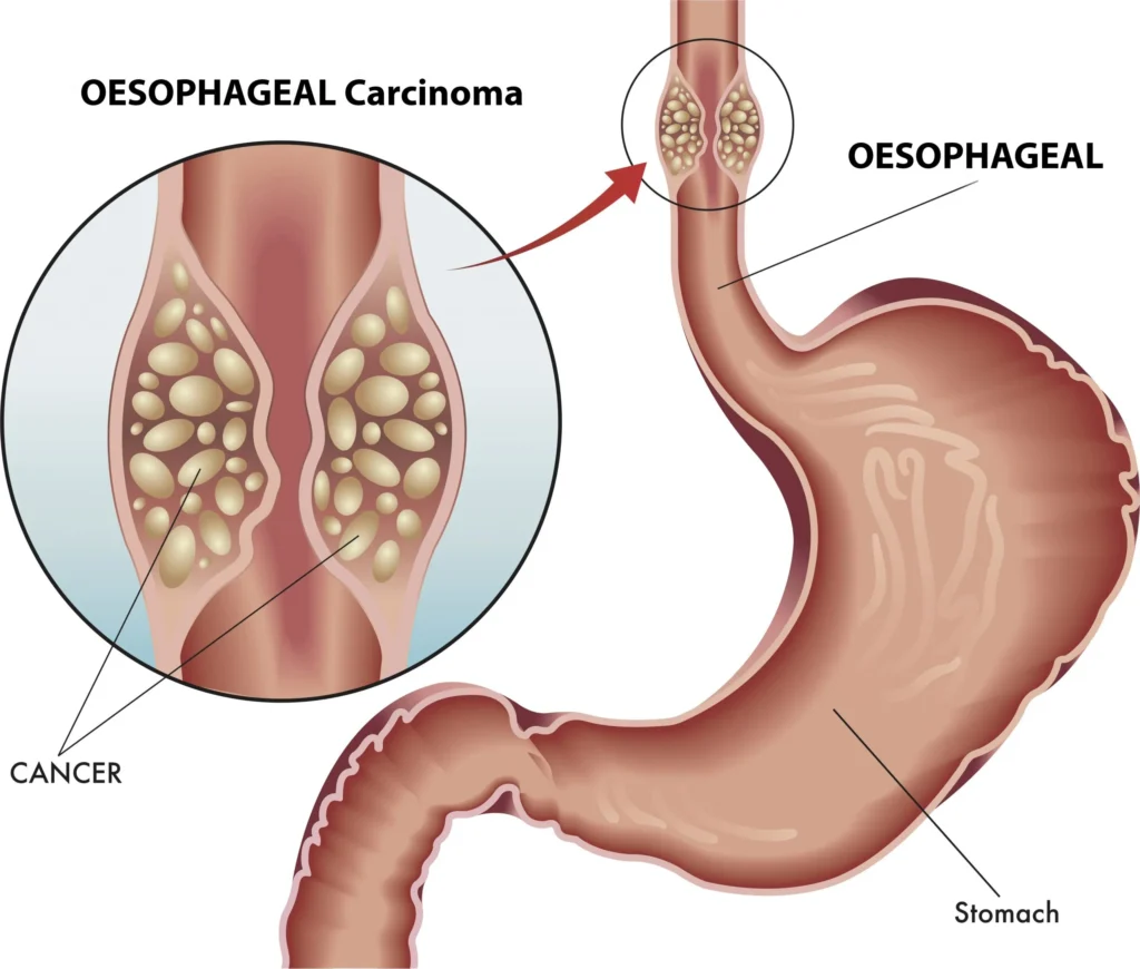 esophageal cancer Is a Tingling Esophagus a Sign of Esophageal Cancer? Digestive