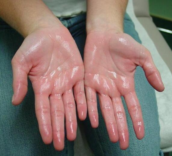 image 24 Am I Sweating Too Much? Could It Be Hyperhidrosis? axillary hyperhidrosis