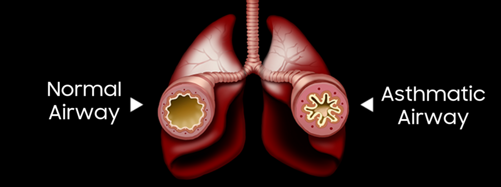 image 4 Symptoms and major precautions for bronchial asthma! Respiratory