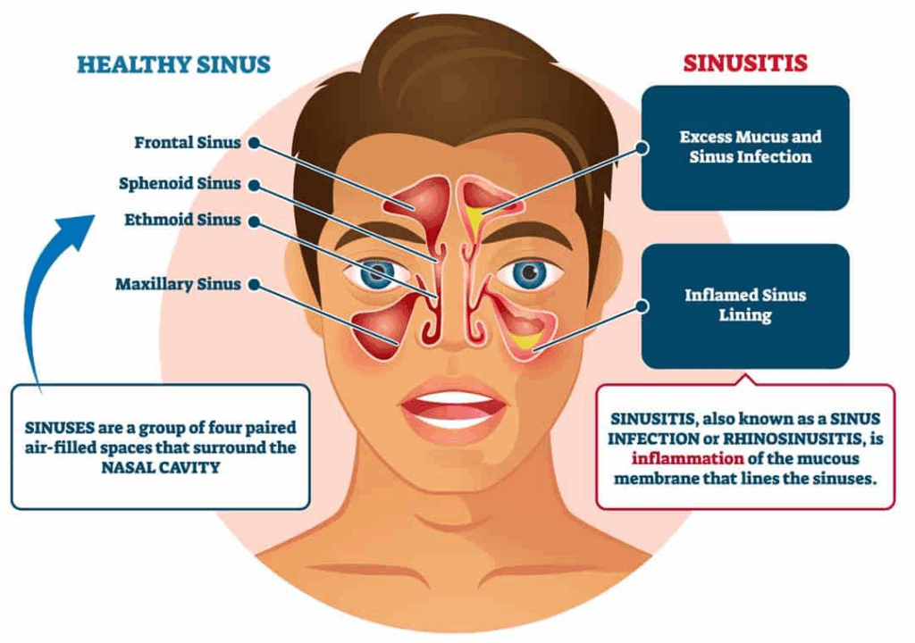 Why Do My Teeth Feel Bruised in the Morning? 7 Common Causes and What You Can Do - 3 Why Do My Teeth Feel Bruised in the Morning? 7 Common Causes and What You Can Do - Sinus